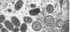 L.A. County Public Health Confirms No Suspected Cases of Monkeypox