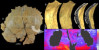 CSUN Prof Uses Super Scanner to Examine Neanderthal Skulls