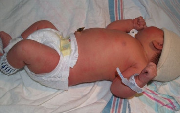 West Coast Health Alliance Recommends Hepatitis B Vaccination for Newborns