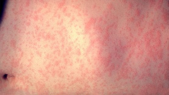 measles virus skin rash