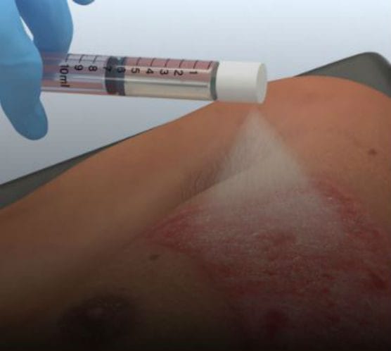 avita medical spray on skin burn treatment